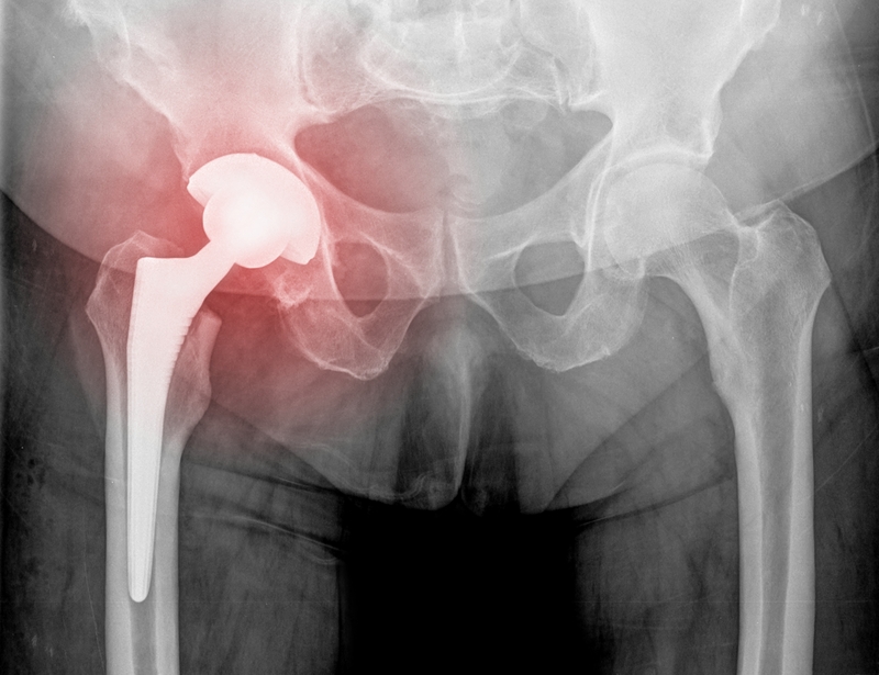 X-Ray of the pelvis, hip joint. hip replacement